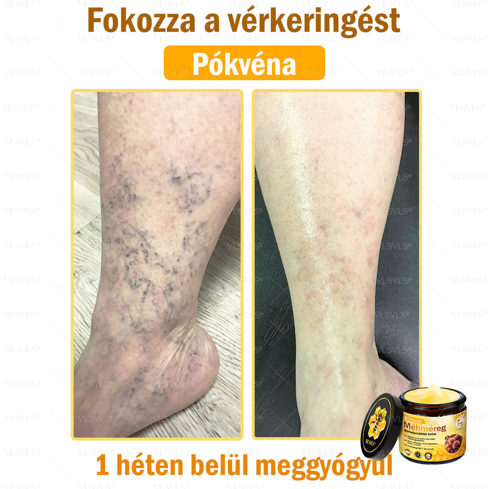 💪VLSVLS® Méhméreg Bőrhelyreállító Krém (👨‍⚕‍CE jóváhagyott)👍✅✅