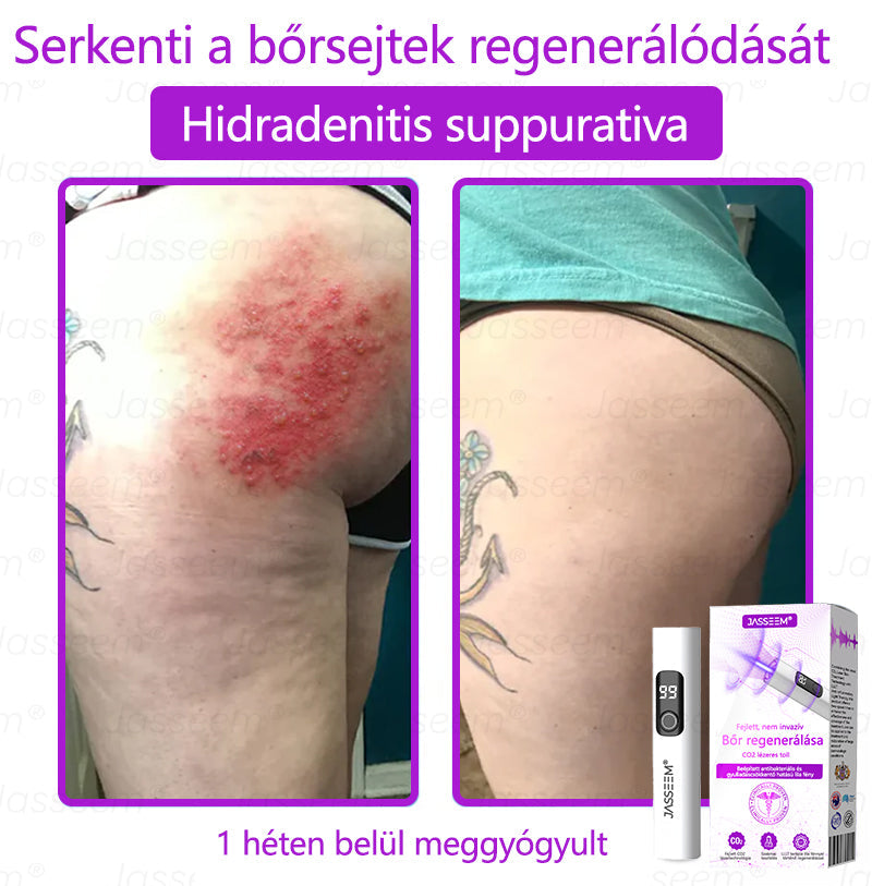 🔥🔥𝐉𝐚𝐬𝐬𝐞𝐞𝐦® Fejlett, nem invazív bőrjavító CO₂ lézeres toll 🎉 (Gyengéden eltávolítja a szemölcsöket, anyajegyeket, öregségi foltokat és bőrkinövéseket – fájdalom és gond nélkül!)