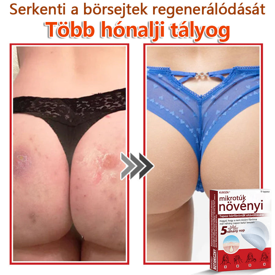 ✅KUBOZN® Mikrotűs Botanikus Bőrkinövés Eltávolító Tapaszok | Magyarországon készült