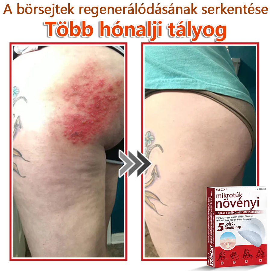 ✅KUBOZN® Mikrotűs Botanikus Bőrkinövés Eltávolító Tapaszok | Magyarországon készült