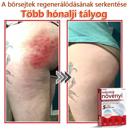 ✅KUBOZN® Mikrotűs Botanikus Bőrkinövés Eltávolító Tapaszok | Magyarországon készült