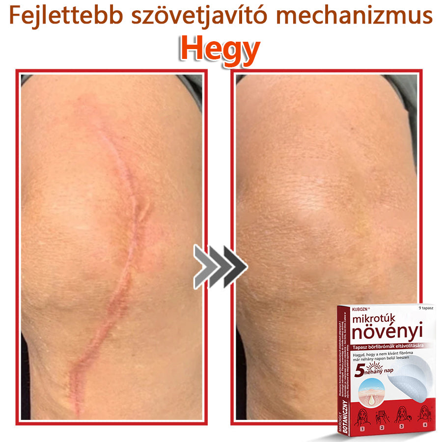 ✅KUBOZN® Mikrotűs Botanikus Bőrkinövés Eltávolító Tapaszok | Magyarországon készült