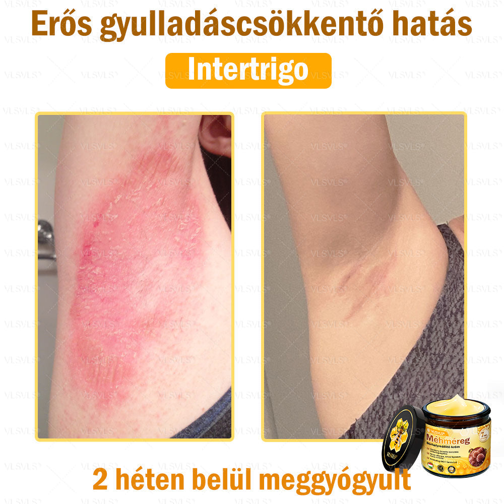 💪VLSVLS® Méhméreg Bőrhelyreállító Krém (👨‍⚕‍CE jóváhagyott)👍✅✅