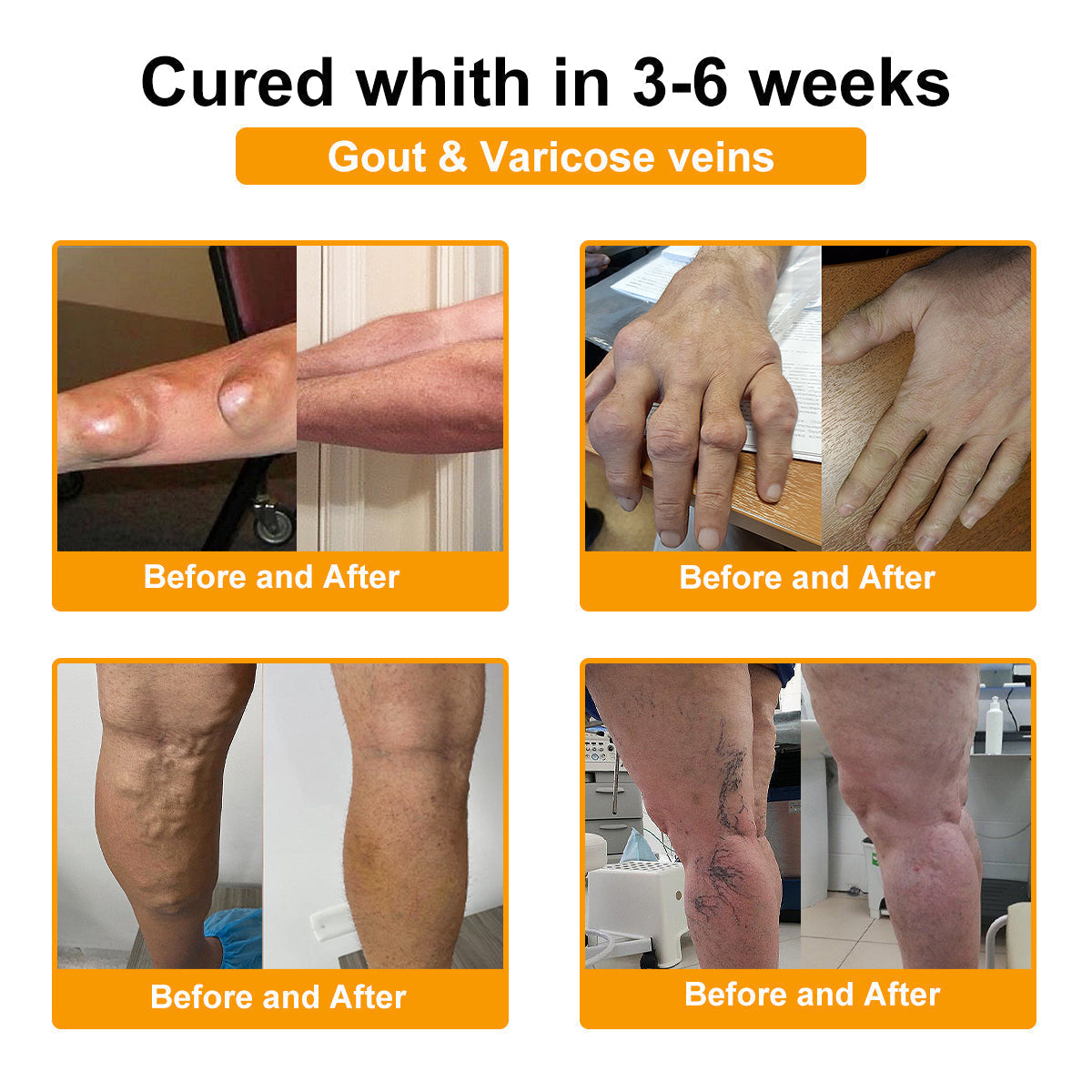 TLOPA® Botulinum Toxin és Méhméreg Fájdalomcsillapító Csontgyógyító Krém🐝 🔥(Kifejezetten időseknek & ortopéd szakorvosok ajánlásával)