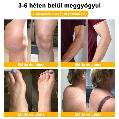 Aeehfeng™ méhméreg és kurkuma ízületi gyulladás terápiás krém (👩 🔬ortopédiai állapotokra és ízületi fájdalmakra👩 🔬 specializálódott)