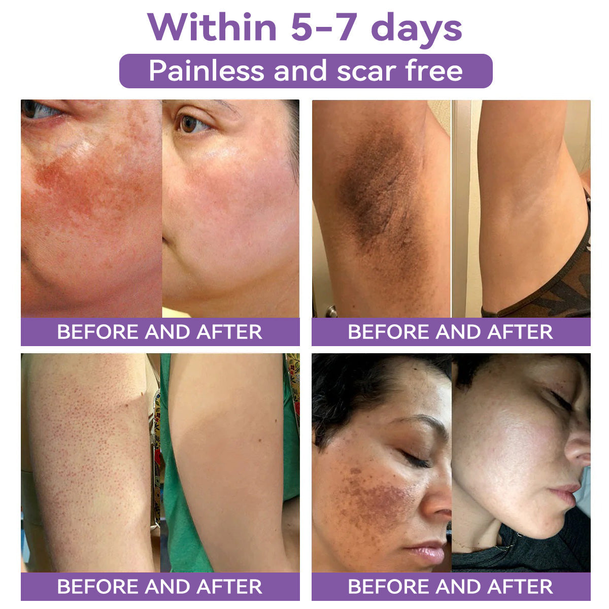 A bőr bizalmának kezdete itt van ✅ Bosstore® Hialuronsav Nano Mikrotűs Javító Tapasz ✴️ Különféle hegekre, striákra, foltokra, keloidokra, keratózisra, aknéra, égési sérülésekre, szemölcsökre, bőrcímkékre és visszértágulatokra.