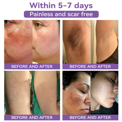 A bőr bizalmának kezdete itt van ✅ Bosstore® Hialuronsav Nano Mikrotűs Javító Tapasz ✴️ Különféle hegekre, striákra, foltokra, keloidokra, keratózisra, aknéra, égési sérülésekre, szemölcsökre, bőrcímkékre és visszértágulatokra.