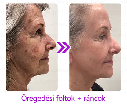 🔥🔥𝐉𝐚𝐬𝐬𝐞𝐞𝐦® Fejlett, nem invazív bőrjavító CO₂ lézeres toll 🎉 (Gyengéden eltávolítja a szemölcsöket, anyajegyeket, öregségi foltokat és bőrkinövéseket – fájdalom és gond nélkül!)