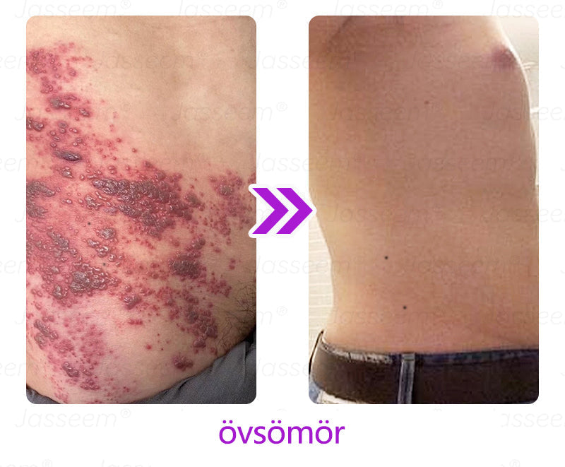 🔥🔥𝐉𝐚𝐬𝐬𝐞𝐞𝐦® Fejlett, nem invazív bőrjavító CO₂ lézeres toll 🎉 (Gyengéden eltávolítja a szemölcsöket, anyajegyeket, öregségi foltokat és bőrkinövéseket – fájdalom és gond nélkül!)