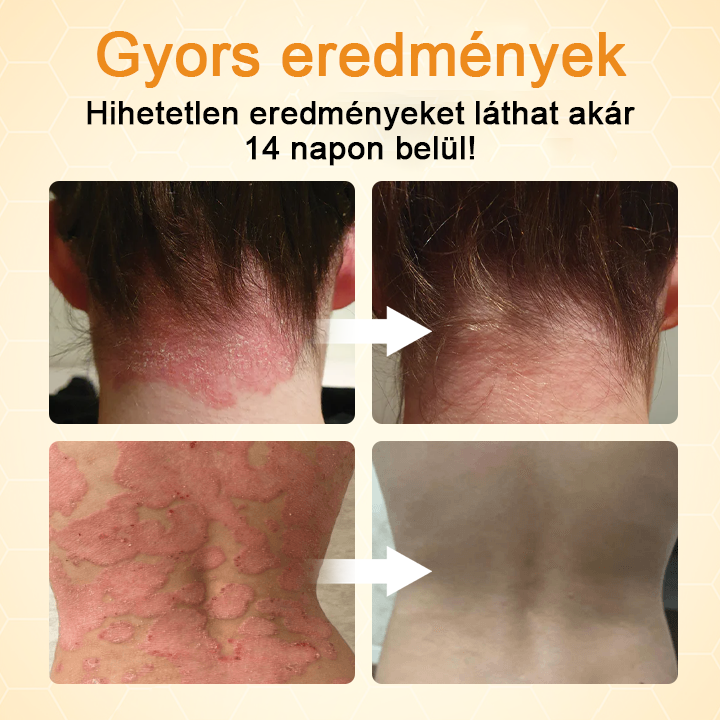 Timilk® BeeLieve Psoriasis bőrápolás🌿🌿