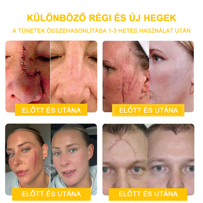 2024 ÚJ Velisse™ méhméreg bőrkrém（🧑‍⚕️AAD ajánlott), a szemölcsök, akné és hegek eltávolítására – többféle bőrbetegség kezelésére