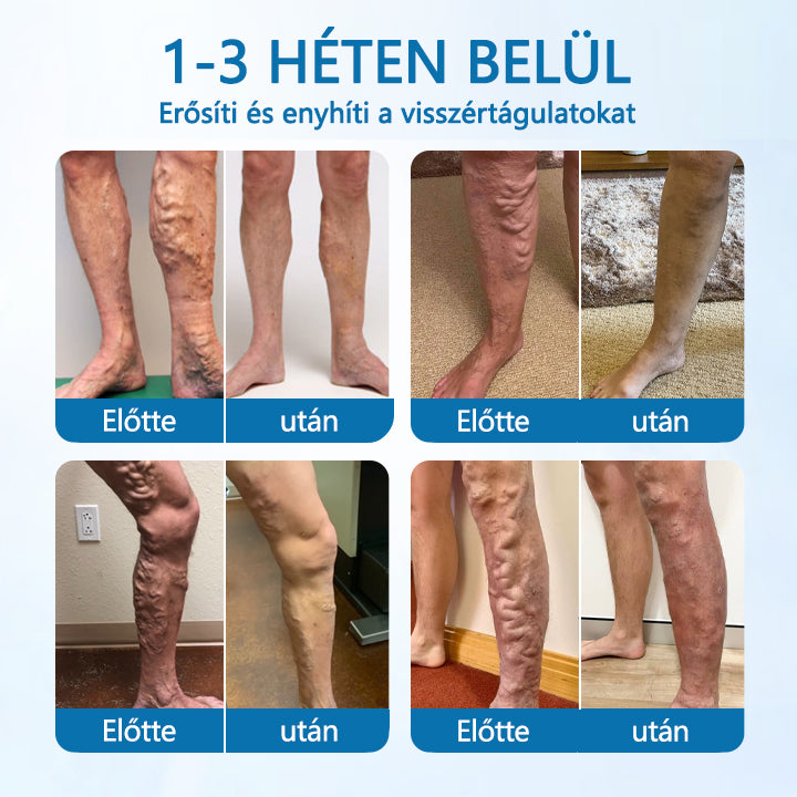 Timilk® VeinGuard Herbal Spray-✅ Klinikailag bizonyítottan 7 nap alatt megszünteti a visszerességet!