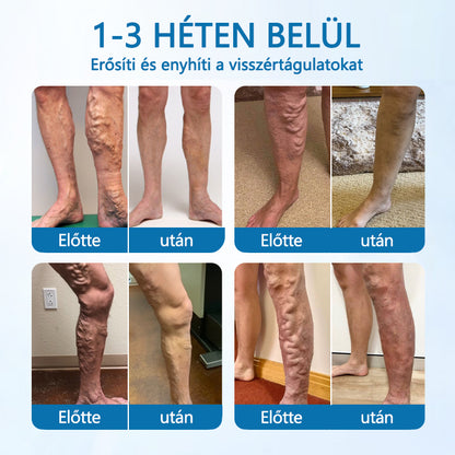 Timilk® VeinGuard Herbal Spray-✅ Klinikailag bizonyítottan 7 nap alatt megszünteti a visszerességet!