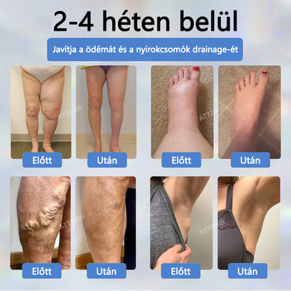 ✅✅ODEIUN® Fekete kömény Ödéma méregtelenítő gyógynövénykrém