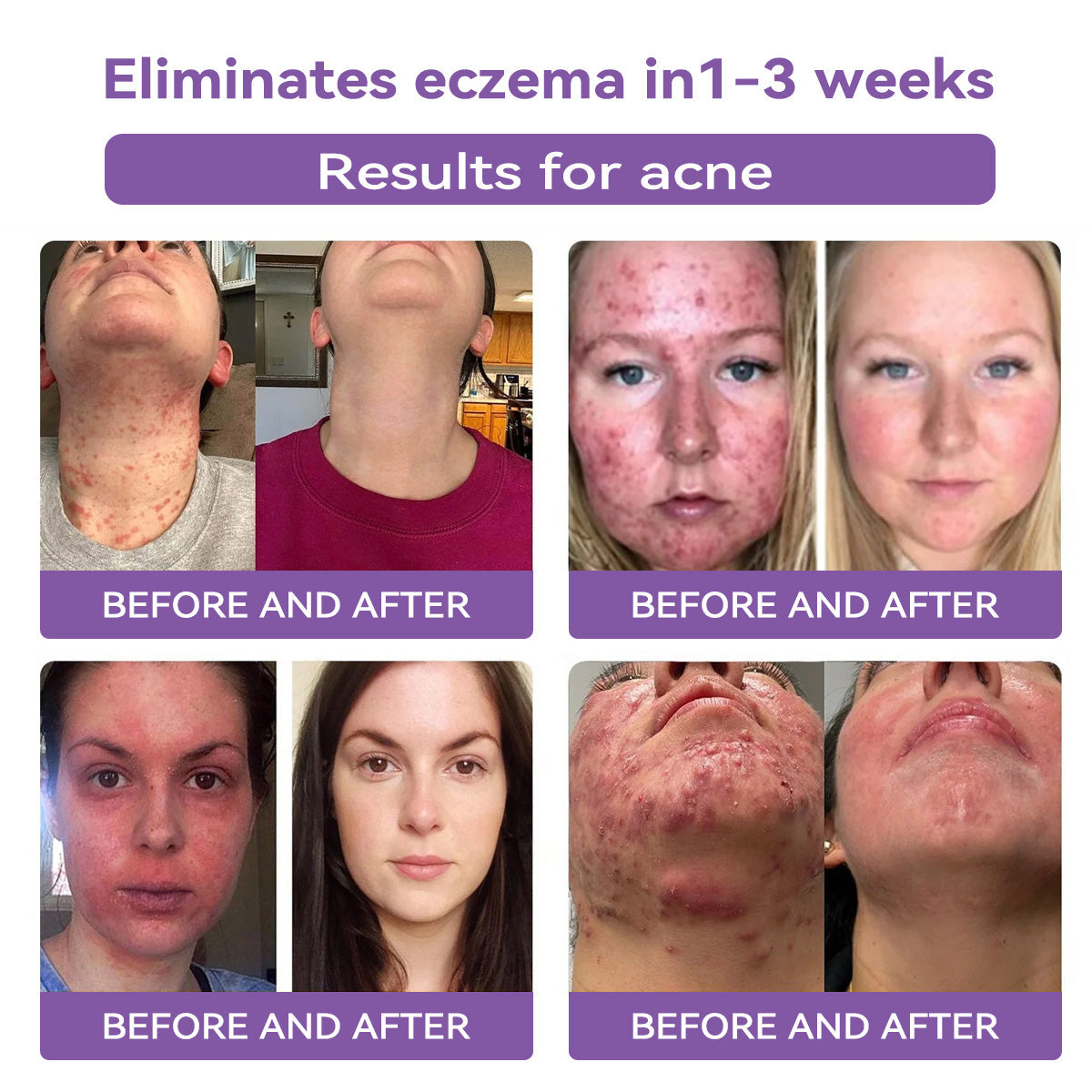 A bőr bizalmának kezdete itt van ✅ Bosstore® Hialuronsav Nano Mikrotűs Javító Tapasz ✴️ Különféle hegekre, striákra, foltokra, keloidokra, keratózisra, aknéra, égési sérülésekre, szemölcsökre, bőrcímkékre és visszértágulatokra.