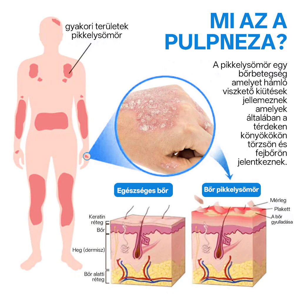 ⭐Laleia® 🎉Magnézium Gyógynövényes Pszoriázis Spray