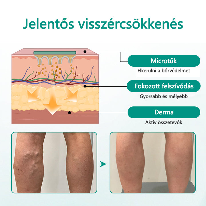 Timilk® LegRenew Visszér Tapasz