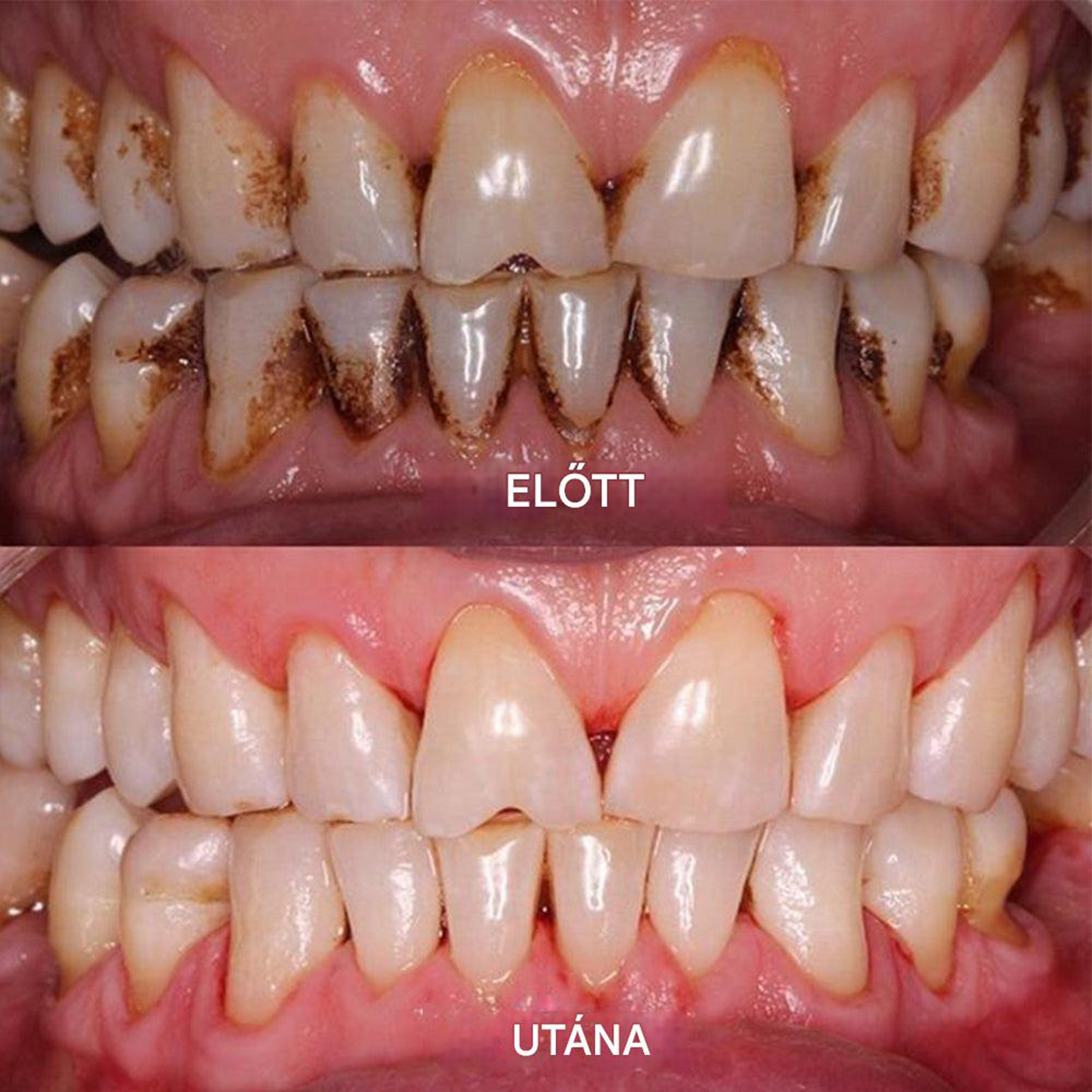 ✅Hivatalos Áruház | Ourlyard™ Tooth Health Mineral Powder🧑🏽‍⚕️ Szerezze meg az American Dental Association (ADA) tanúsítványát (kezeli a parodontitist és a szájfekélyeket, megelőzi a fogak elvesztését és helyreállítja a fogíny recesszióját)🔥