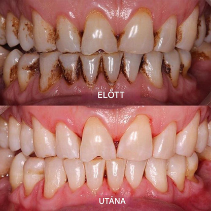 ✅Hivatalos Áruház | Ourlyard™ Tooth Health Mineral Powder🧑🏽‍⚕️ Szerezze meg az American Dental Association (ADA) tanúsítványát (kezeli a parodontitist és a szájfekélyeket, megelőzi a fogak elvesztését és helyreállítja a fogíny recesszióját)🔥