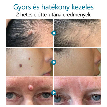 ✅Bikenda® LumeSkin anyajegy és szemölcs eltávolító lézeres toll