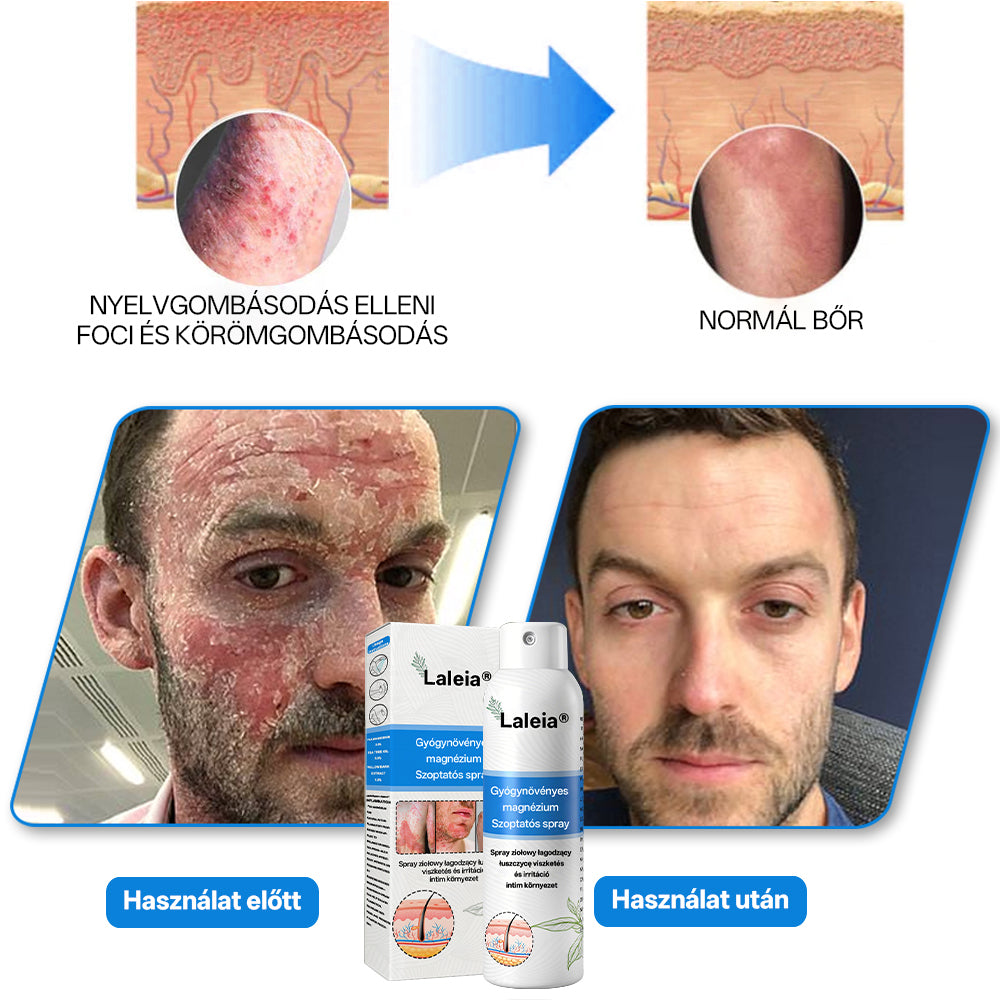 ⭐Laleia® 🎉Magnézium Gyógynövényes Pszoriázis Spray
