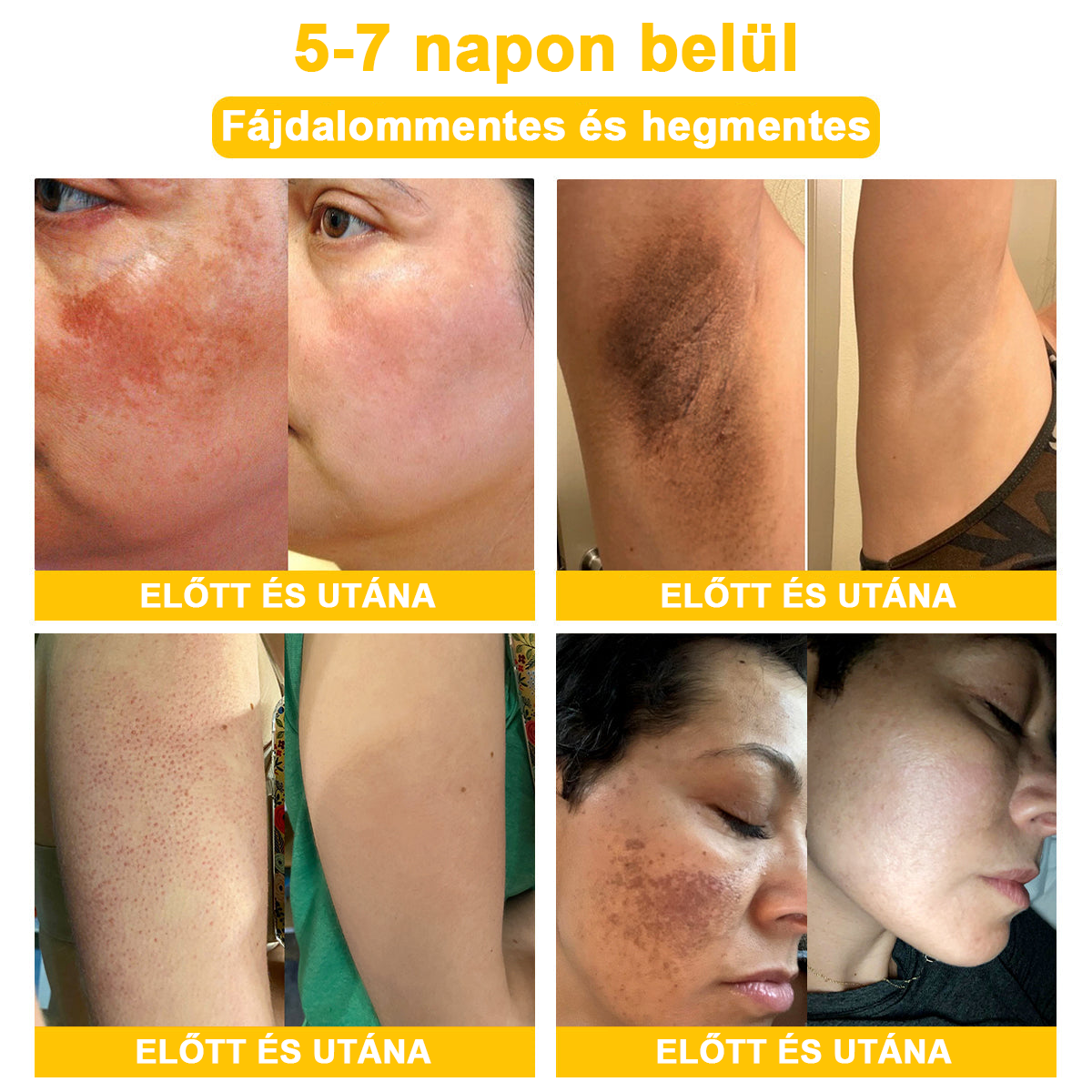 2024 ÚJ Velisse™ méhméreg bőrkrém（🧑‍⚕️AAD ajánlott), a szemölcsök, akné és hegek eltávolítására – többféle bőrbetegség kezelésére