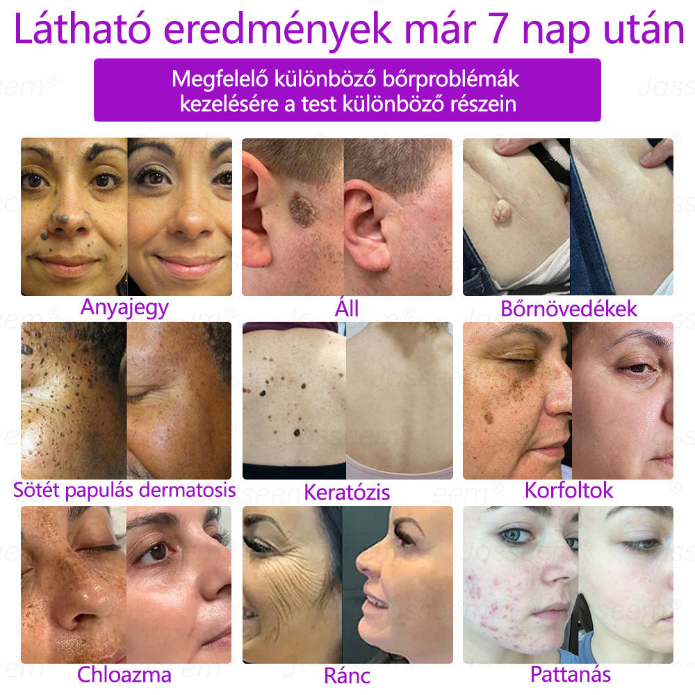 🔥🔥𝐉𝐚𝐬𝐬𝐞𝐞𝐦® Fejlett, nem invazív bőrjavító CO₂ lézeres toll 🎉 (Gyengéden eltávolítja a szemölcsöket, anyajegyeket, öregségi foltokat és bőrkinövéseket – fájdalom és gond nélkül!)