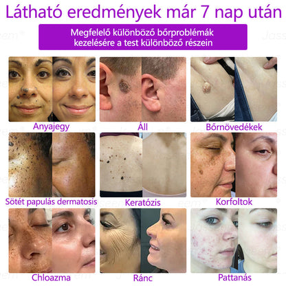 🔥🔥𝐉𝐚𝐬𝐬𝐞𝐞𝐦® Fejlett, nem invazív bőrjavító CO₂ lézeres toll 🎉 (Gyengéden eltávolítja a szemölcsöket, anyajegyeket, öregségi foltokat és bőrkinövéseket – fájdalom és gond nélkül!)