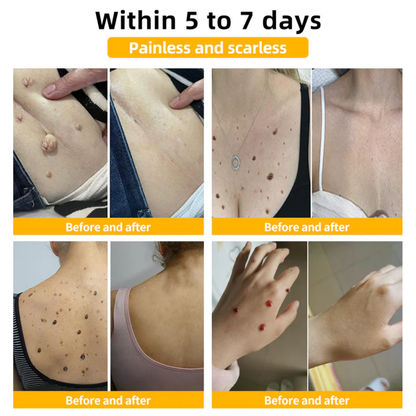 AEXZR™ Méhméreg vakond és szemölcs kezelési krém