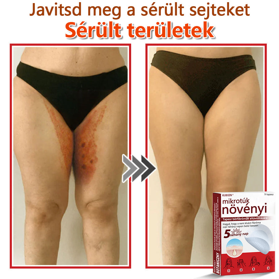 ✅KUBOZN® Mikrotűs Botanikus Bőrkinövés Eltávolító Tapaszok | Magyarországon készült