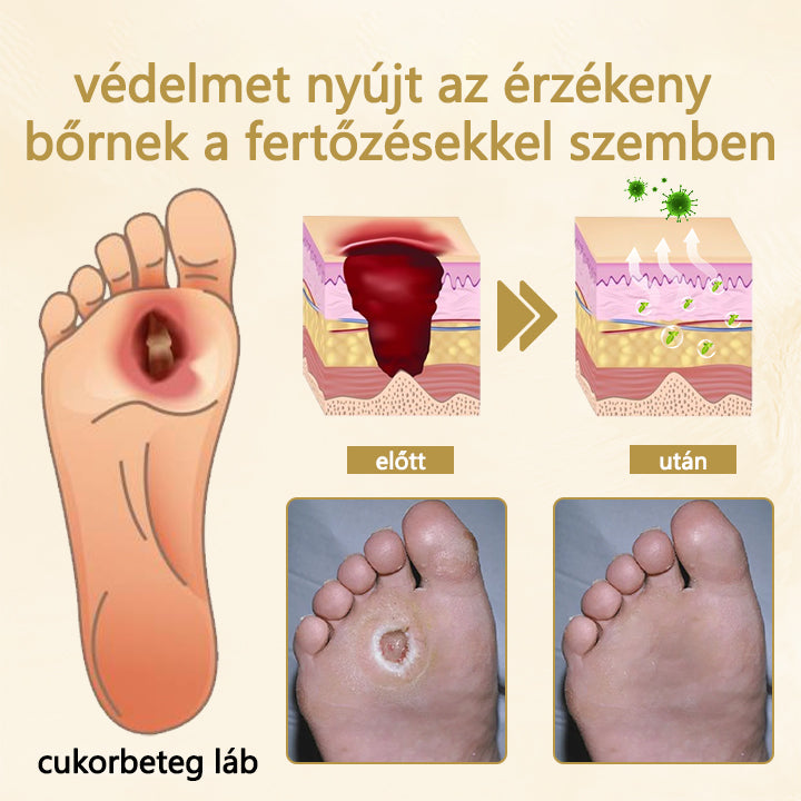 ✅Timilk® Diabetikus lábgyógyító spray - Méhméreggel átitatott