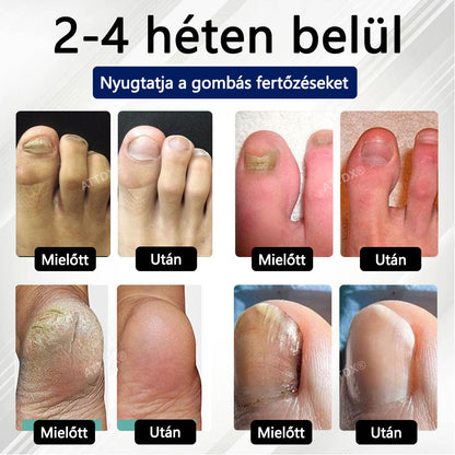 Croaie® Fungiclear Bee Therapy Nail Spray🎁