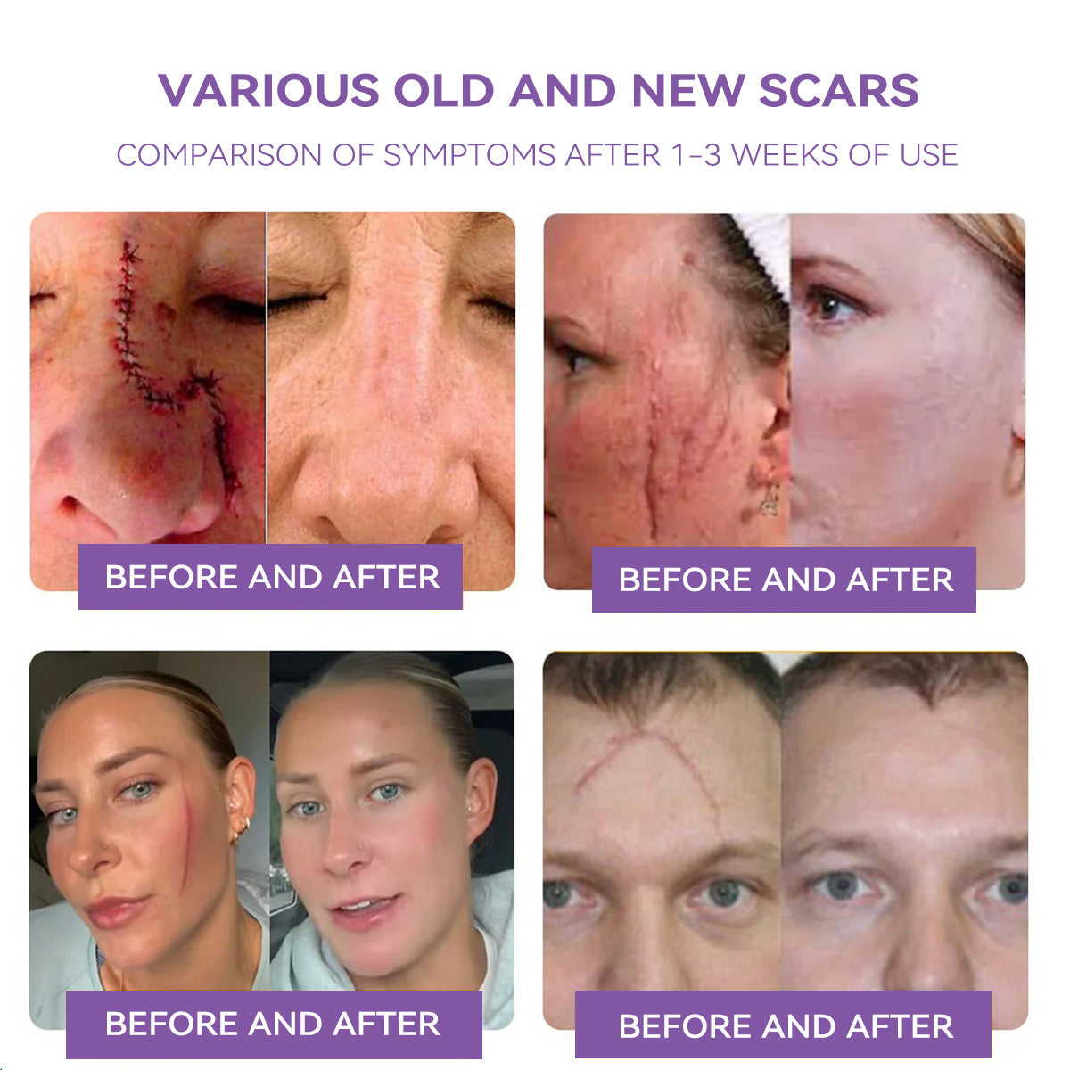 A bőr bizalmának kezdete itt van ✅ Bosstore® Hialuronsav Nano Mikrotűs Javító Tapasz ✴️ Különféle hegekre, striákra, foltokra, keloidokra, keratózisra, aknéra, égési sérülésekre, szemölcsökre, bőrcímkékre és visszértágulatokra.