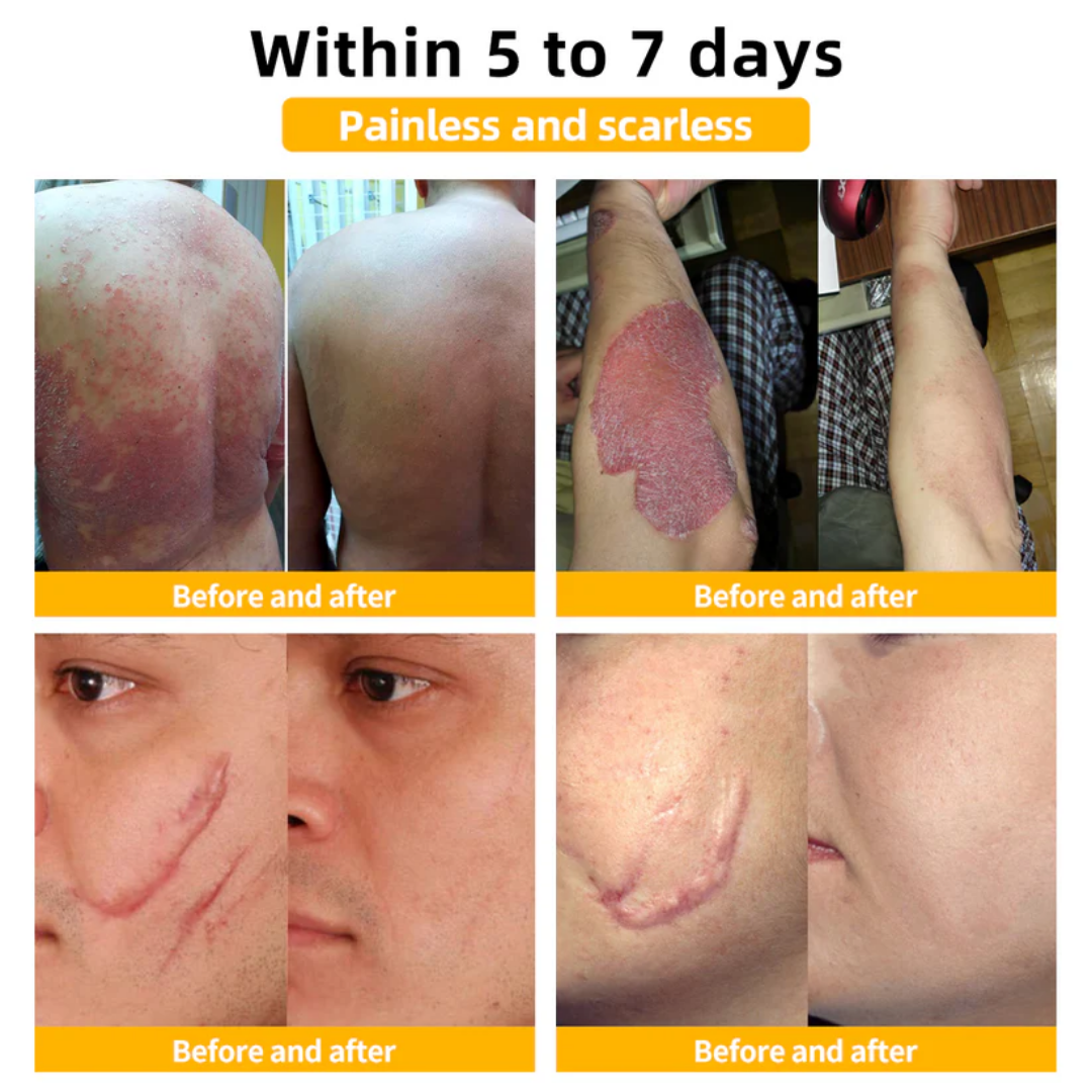 AEXZR™ Méhméreg vakond és szemölcs kezelési krém