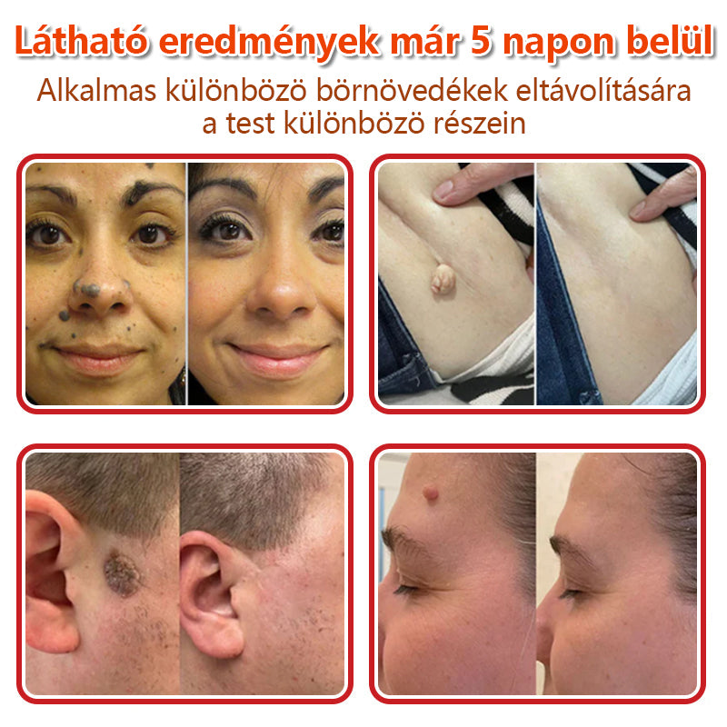 ✅KUBOZN® Mikrotűs Botanikus Bőrkinövés Eltávolító Tapaszok | Magyarországon készült