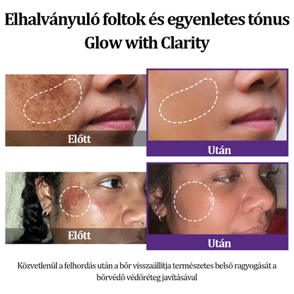 🔥🔥𝐎𝐆𝐘É𝐈 által jóváhagyva | 𝐅𝐮𝐫𝐳𝐞𝐫𝐨® 𝐄𝐏𝐈𝐆𝐋𝐎𝐖 𝐌𝐞𝐥𝐚𝐧𝐄𝐗 Fejlett Hiperpigmentáció Elleni Krém