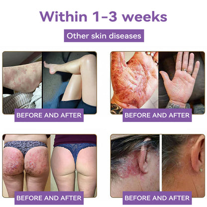 A bőr bizalmának kezdete itt van ✅ Bosstore® Hialuronsav Nano Mikrotűs Javító Tapasz ✴️ Különféle hegekre, striákra, foltokra, keloidokra, keratózisra, aknéra, égési sérülésekre, szemölcsökre, bőrcímkékre és visszértágulatokra.