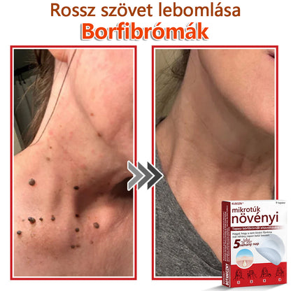 ✅KUBOZN® Mikrotűs Botanikus Bőrkinövés Eltávolító Tapaszok | Magyarországon készült