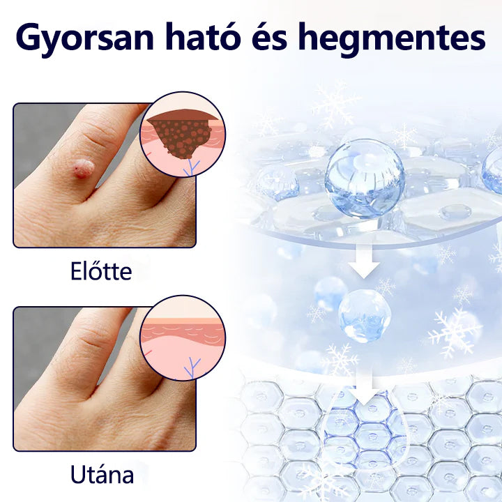 Timilk®🌲🌲🌲 WartErase – Fagyasztó Szemölcseltávolító Spray