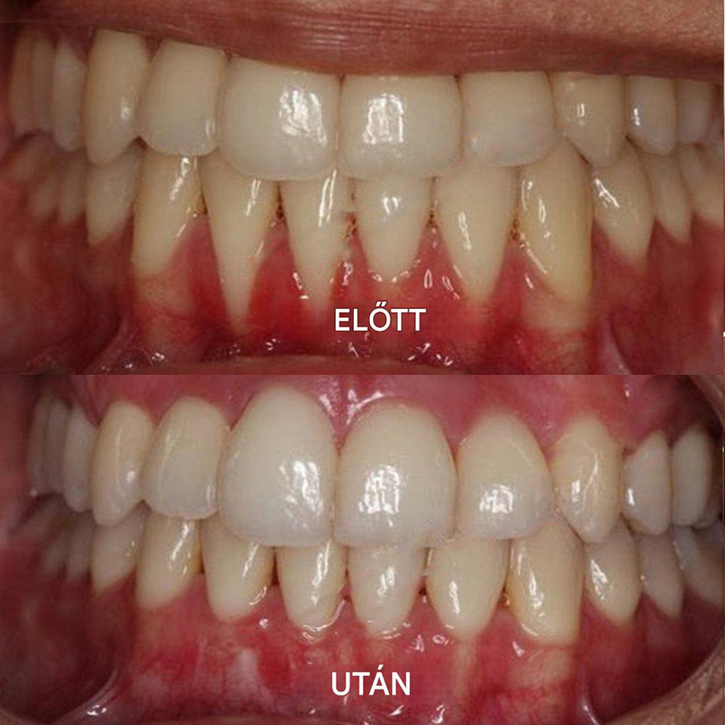 ✅Hivatalos Áruház | Ourlyard™ Tooth Health Mineral Powder🧑🏽‍⚕️ Szerezze meg az American Dental Association (ADA) tanúsítványát (kezeli a parodontitist és a szájfekélyeket, megelőzi a fogak elvesztését és helyreállítja a fogíny recesszióját)🔥