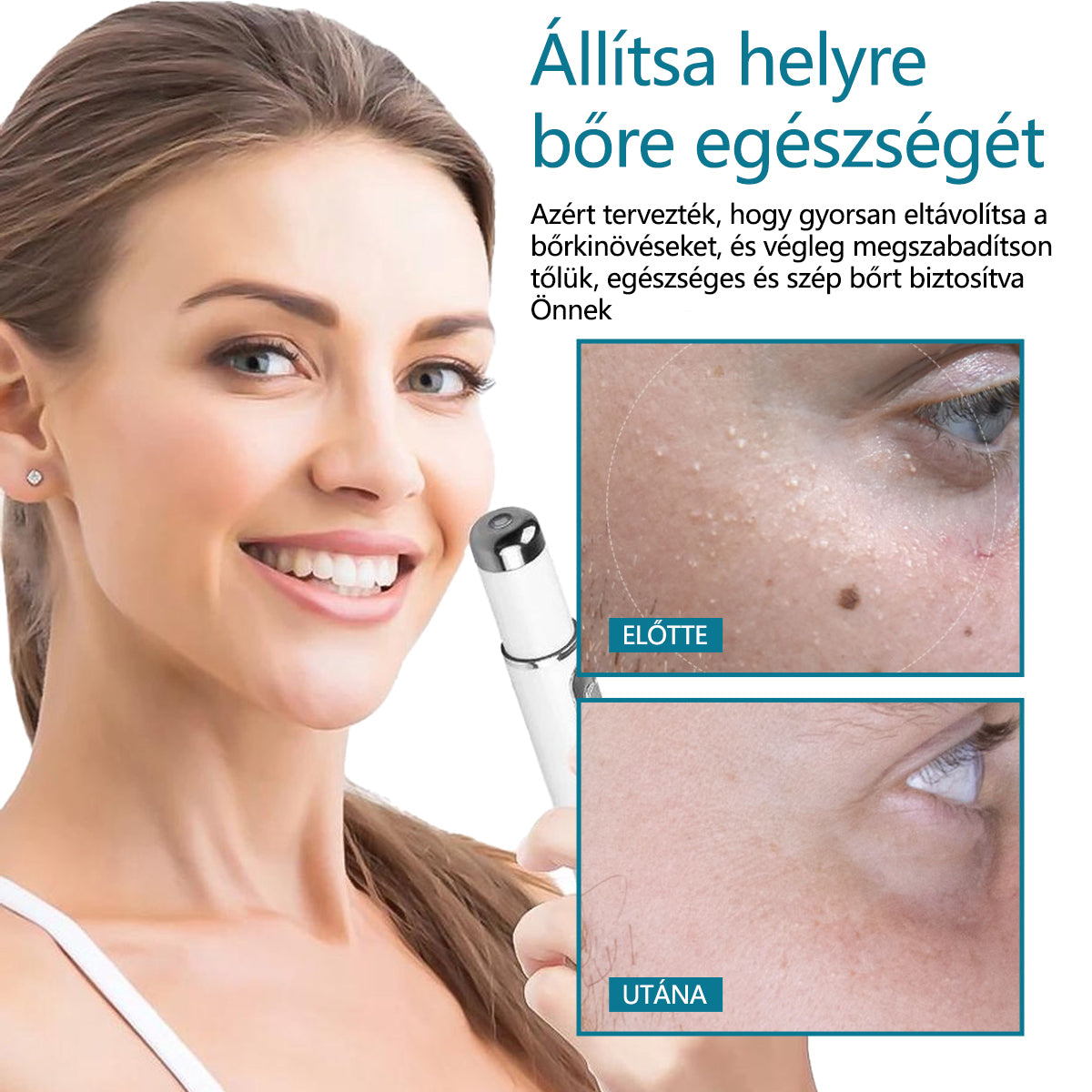 ✅Bikenda® LumeSkin anyajegy és szemölcs eltávolító lézeres toll