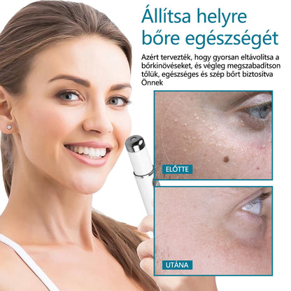 ✅Bikenda® LumeSkin anyajegy és szemölcs eltávolító lézeres toll