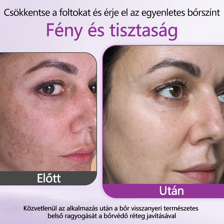 ✨✨✨Ceoerty® MelantraX Advanced Anti-Hyperpigmentáció elleni esszencia