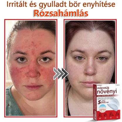 ✅KUBOZN® Mikrotűs Botanikus Bőrkinövés Eltávolító Tapaszok | Magyarországon készült