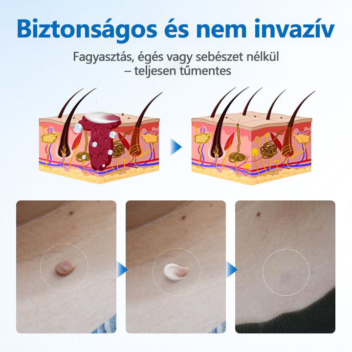 👨‍⚕️Timilk® TagGone szemölcs eltávolító krém