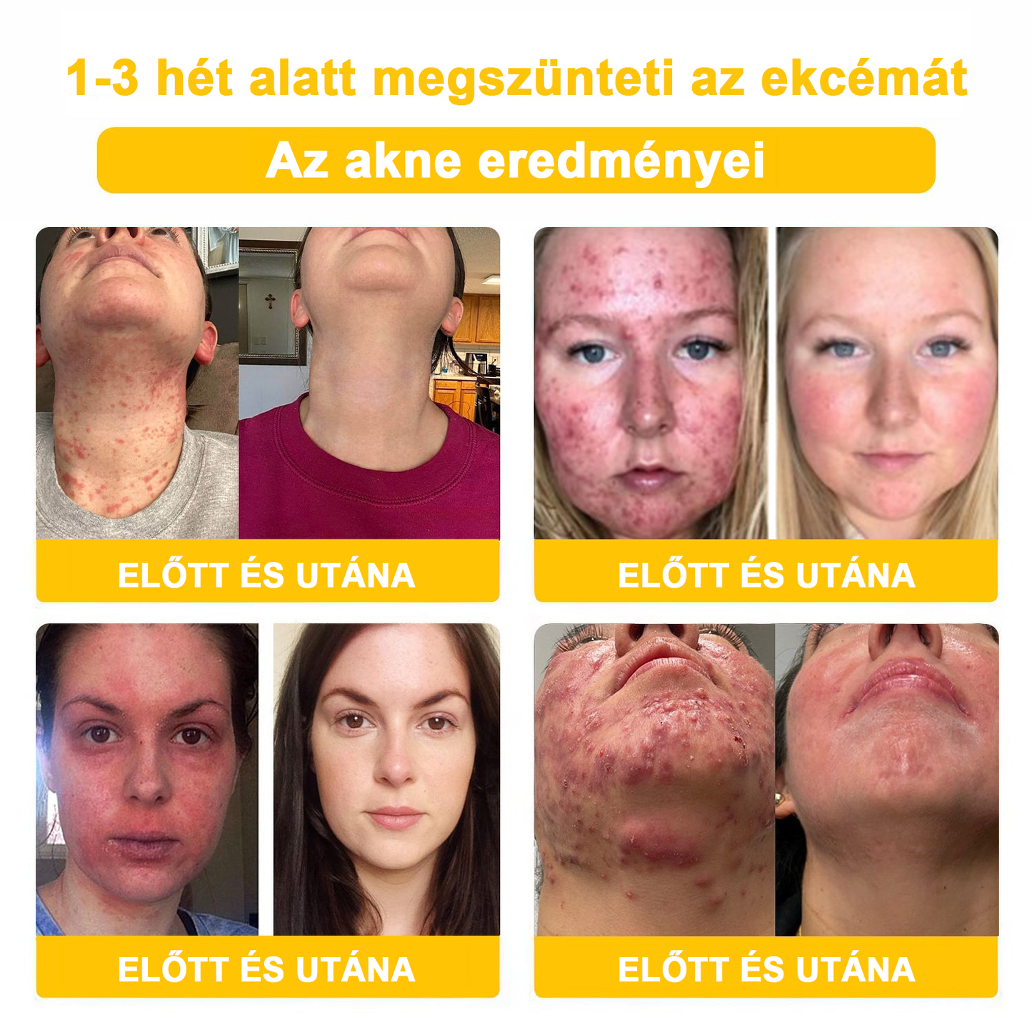 2024 ÚJ Velisse™ méhméreg bőrkrém（🧑‍⚕️AAD ajánlott), a szemölcsök, akné és hegek eltávolítására – többféle bőrbetegség kezelésére