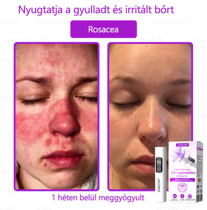 🔥🔥𝐉𝐚𝐬𝐬𝐞𝐞𝐦® Fejlett, nem invazív bőrjavító CO₂ lézeres toll 🎉 (Gyengéden eltávolítja a szemölcsöket, anyajegyeket, öregségi foltokat és bőrkinövéseket – fájdalom és gond nélkül!)