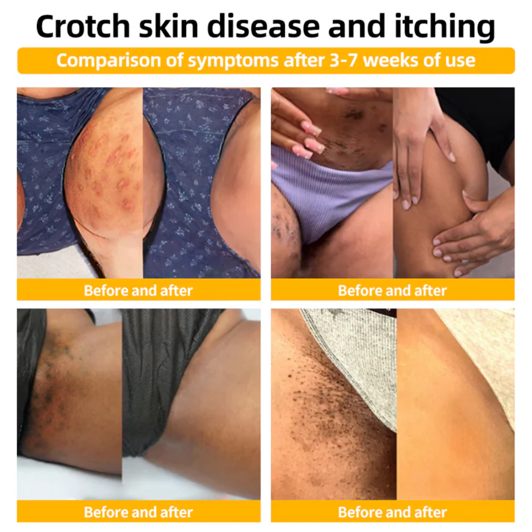 AEXZR™ Méhméreg vakond és szemölcs kezelési krém