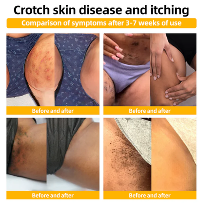 AEXZR™ Méhméreg vakond és szemölcs kezelési krém