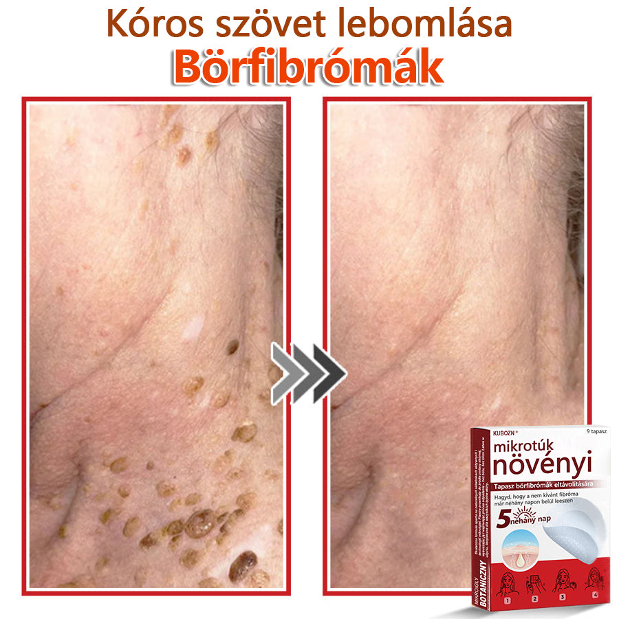 ✅KUBOZN® Mikrotűs Botanikus Bőrkinövés Eltávolító Tapaszok | Magyarországon készült